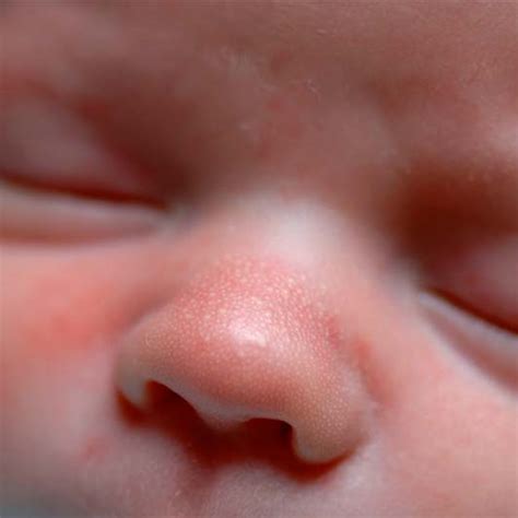Common Newborn Rashes Healthy Momandbaby