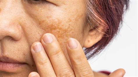 How To Treat And Prevent Hyperpigmentation And Melasma Chatelaine