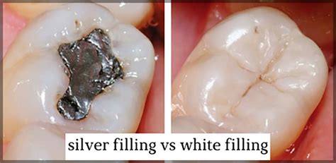 Difference Between Silver And White Fillings