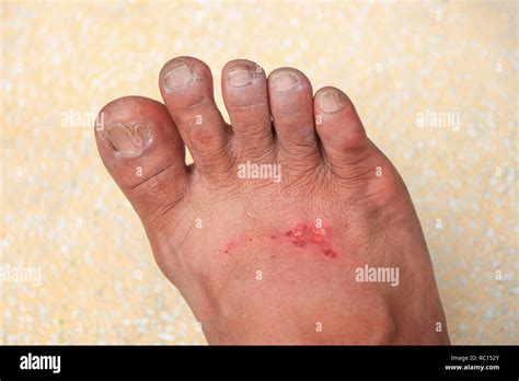 Foot Wound Becomes Infected Select Focus With Shallow Depth Of Field