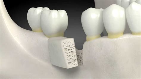 What Is A Dental Bone Graft Youtube