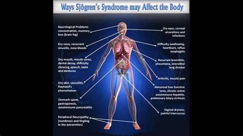 Sjogren Syndrome Neurological Symptoms Captions Update Trendy
