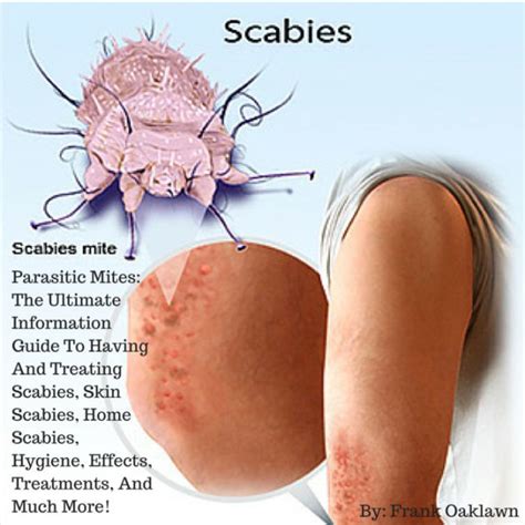 Scabies Parasitic Mites The Ultimate Information Guide To Having And