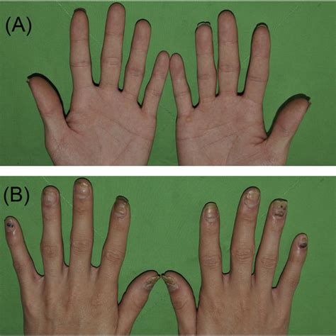 Pdf Palmoplantar Pustulosis With Severe Psoriatic Nail Dystrophy In A