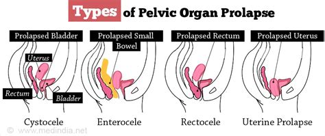 Pelvic Organ Prolapse Types Causes Symptoms Diagnosis Treatment