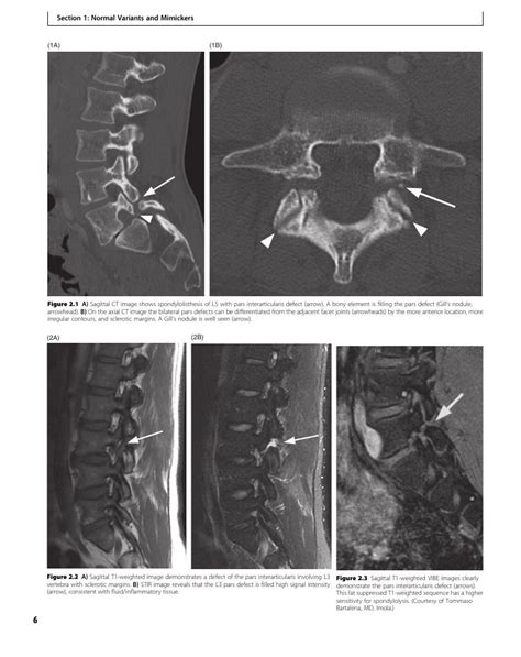 Pars Defects Case 2 Clinical Imaging Of Spinal Trauma