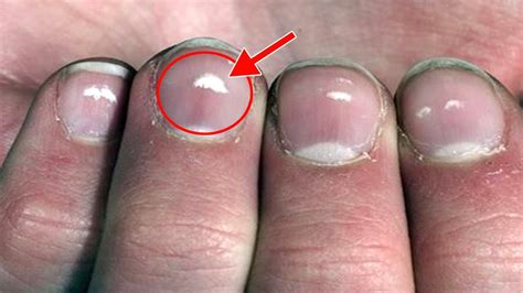 What Causes White Spots On Fingernails
