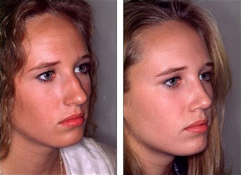 Check the ranking of 20 plastic surgery republic of korea clinics based on she accompanied me throughout the appointment and translated when necessary. Best 25+ Nose jobs ideas on Pinterest | Rhinoplasty, Nose ...