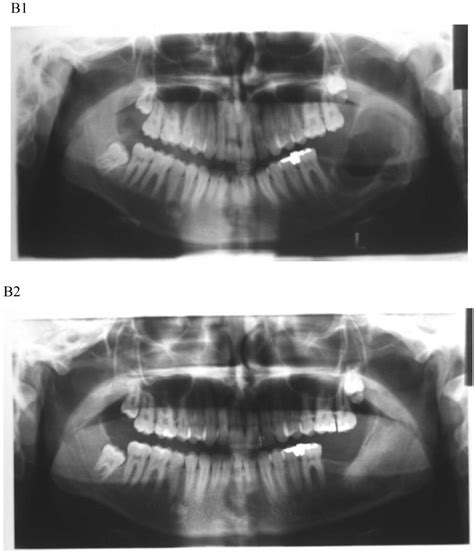 Figure 1 From Cystic Lesions Of The Jaws A Clinicopathological Study
