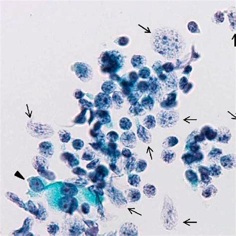 Mucosa Associated Lymphoid Tissue Lymphoma Two Elongated Nuclei