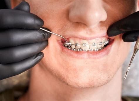 5 Helpful Tips To Fix Your Loose Braces Brackets