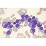 Plasma Cell Leukemia  1