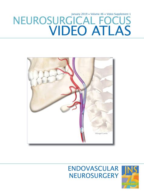 Transarterial Embolization Of An Internal Maxillary Artery