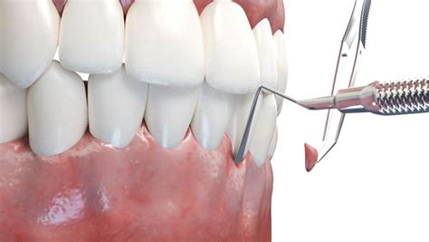 When Is A Gum Graft Recommended Brighton Periodontal And Implant