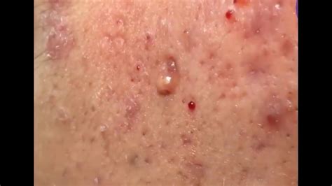 Most Satisfying Blackheads Removal Get Rid Of Blackheads On Face At