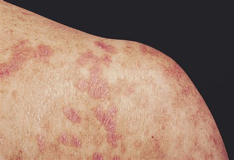 Lichenoid Dermatitis In Paraneoplastic Pemphigus Dermatology Jama