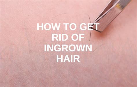 How To Get Rid Of Ingrown Hair The Idle Men