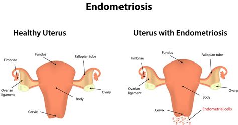 You've heard of endometriosis, but what about adenomyosis? What Is Endometriosis?