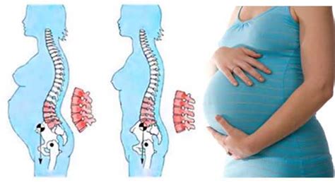 Lower Back Pain Early Pregnancy Advanced Sports Chiropractic