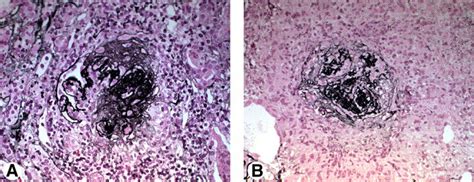 The glomerular basement membrane is the fused basement membrane of both the. References in Coexistence of Anti-Glomerular Basement ...