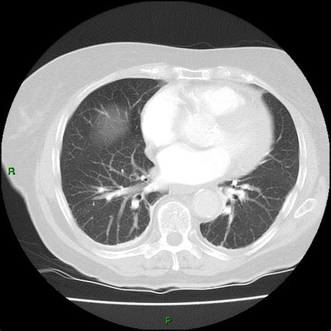 Type A Aortic Dissection Radiology Case