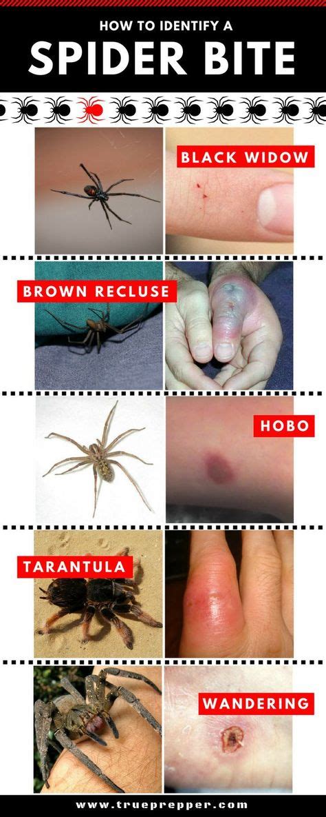 How To Identify A Spider Bite And Treat It Spider Bites Survival Life Hacks Survival Skills