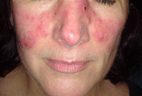 Systemic Lupus Erythematosus 2 Picture Image On