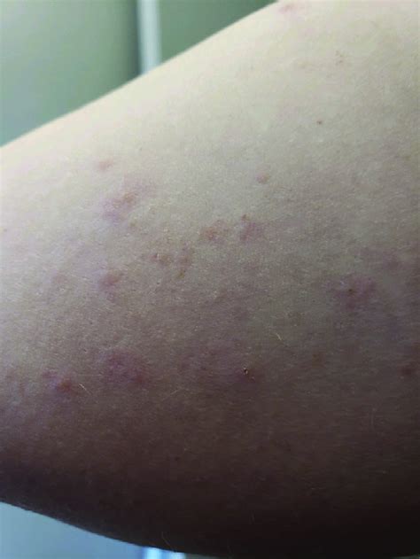 Case 5 With Urticarial Papular Rash On The Contralateral Aspect Of The