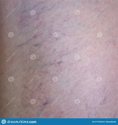 Woman Leg Close Up With Beginning Varicose Veins Stock Photo Image Of