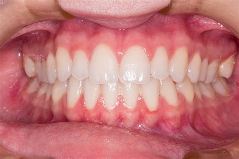 Тоа фрейзер, робин грэйс, джим микл. Teeth Smile · Free photo on Pixabay