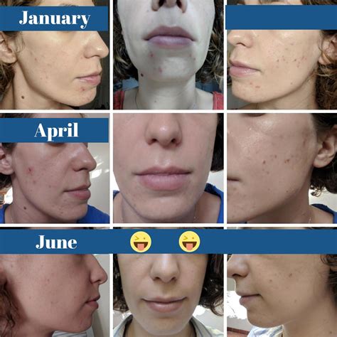B A Evolution And Disappearance Over Six Months Of Cystic Acne On