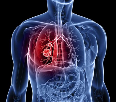 About Health Lung Cancer