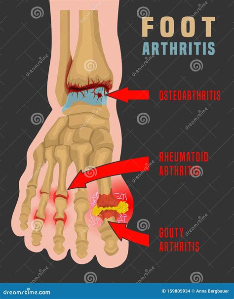 Arthritis Infographic Poster Vector Illustration