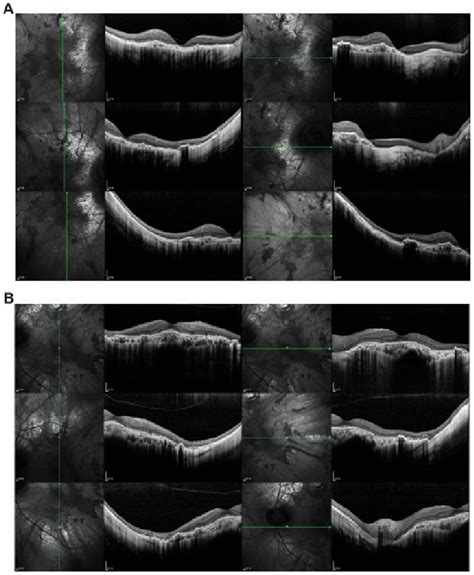 Fundus Autofluorescence Image Demonstrating Areas Of Residual Retinal
