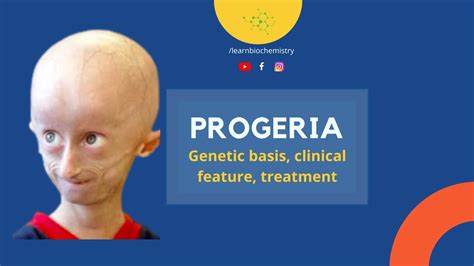 Hutchinson Gilford Progeria Syndrome Genetic Basis Treatment And