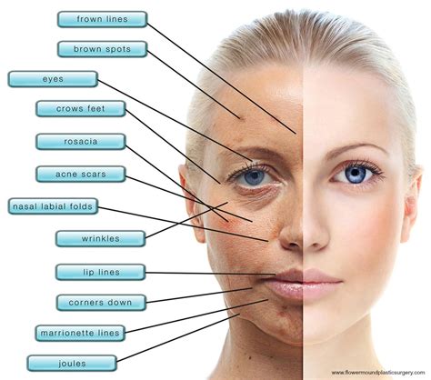 What Are The Advantages Of The Sciton Bbl Photofacial Versus An Ipl