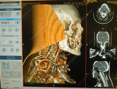 Skull 3d Scan Stock Image C0040350 Science Photo Library