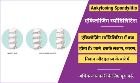 एंकिलोज़िंग स्पोंडिलिटिस Ankylosing Spondylitis In Hindi Symptoms
