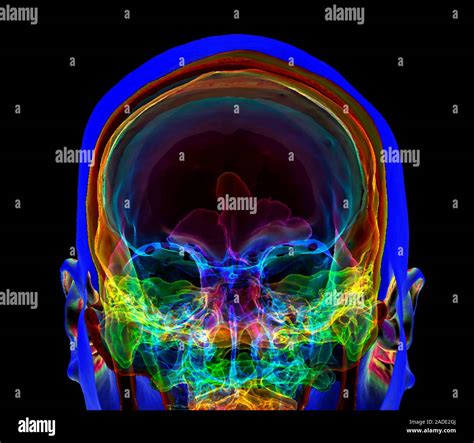 Cabeza Y Cráneo 3d Color Tomografía Axial Computada Tac De Una Vista