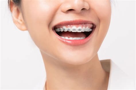 Dental Braces And Their Challenges Wisdom Teeth Reopelle Orthodontics