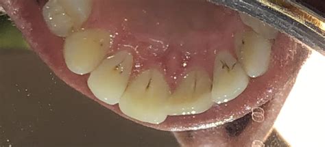 What Are These Black Lines On The Back Of My Teeth Rdentistry