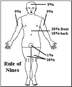 Using the rule of nines burn chart helps doctors access the severity of burns on a patient. General Medical Officer (GMO) Manual: Clinical Section: Burns
