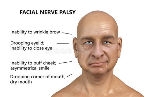 Facial Palsy Causes Telegraph
