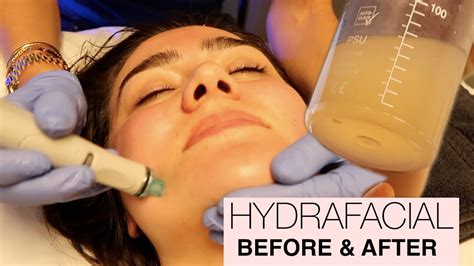 Getting My Pores Sucked Clean My First Hydrafacial Experience Before And After Youtube