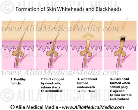 Formation Of Skin Blackhead And Whitehead Alila Medical Images