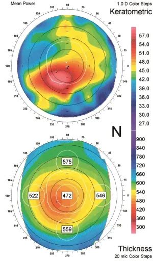 Keratoconus Topography American Academy Of Ophthalmology