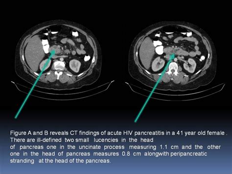 A And B Ct Scan Of Acute Pancreatitis In A 41 Year Old Female Showing