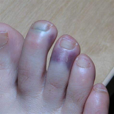 ‘covid Toes That Turn Purple From The Disease Can Last For Five Months