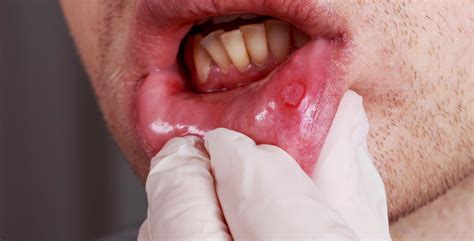 Brits Have Extremely Poor Knowledge Of Oral Cancer Uk