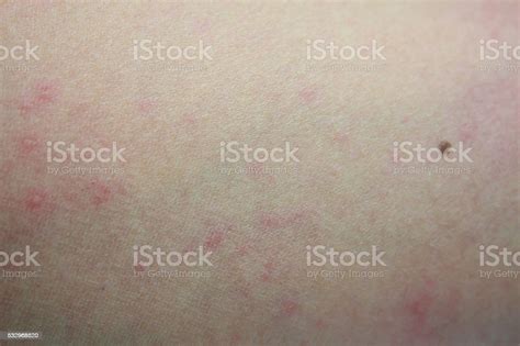 Ill Allergic Rash Dermatitis Eczema Skin Of Patient Stock Photo